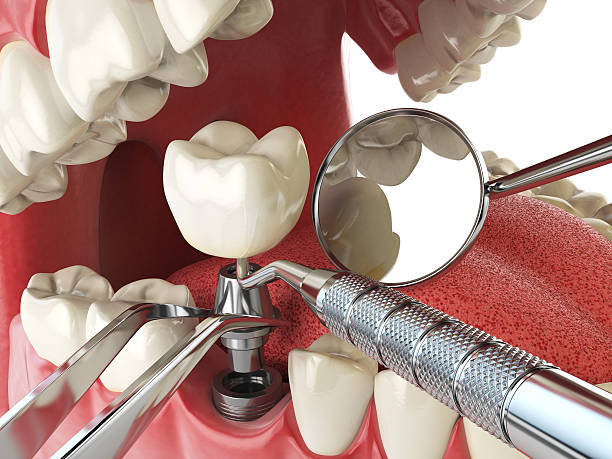 Best Urgent Care for Lost Fillings or Crowns in Osage, IA